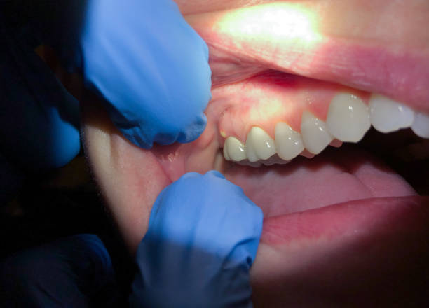 Best Emergency Dental Care for Broken or Chipped Teeth in Gilbert, IA