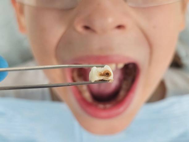 Best Emergency Tooth Extraction in Gilbert, IA